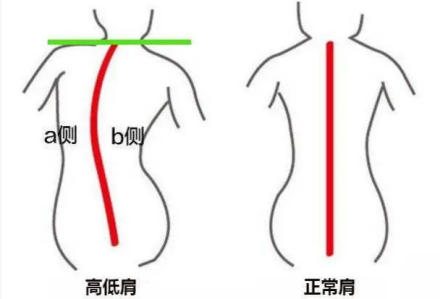 科普时刻丨快看，脊柱侧弯已纳入学生体检！我们一起关注脊柱健康