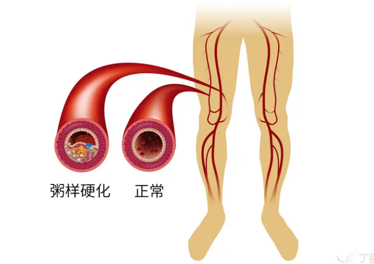 腿凉脚麻，就是老寒腿？这可不一定哦…