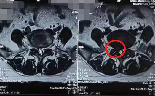 科室投稿 | 疫情下的坚守！陕西冶金医院脊柱科微创解决腰椎间盘突出症！
