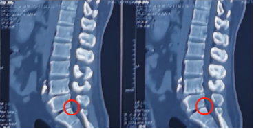 没有假期的中年人遇上腰腿痛，如何是好？一个小孔快速解决腰椎间盘突出问题！