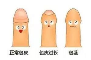 夏季包皮手术家长须知，这5点你要知道！
