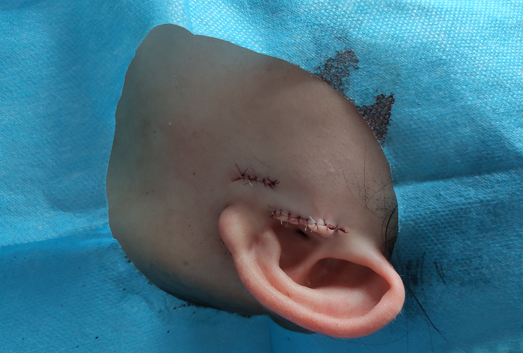 耳朵长了&ldquo;小赘肉&rdquo;咋办？丨我院成功为一名&ldquo;先天性附耳&rdquo;小患儿进行了手术切除~