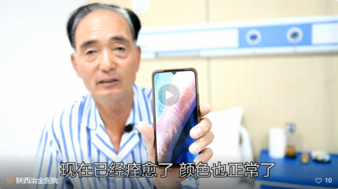 案例实记丨夫妻俩先后来院治疗静脉曲张老烂腿！