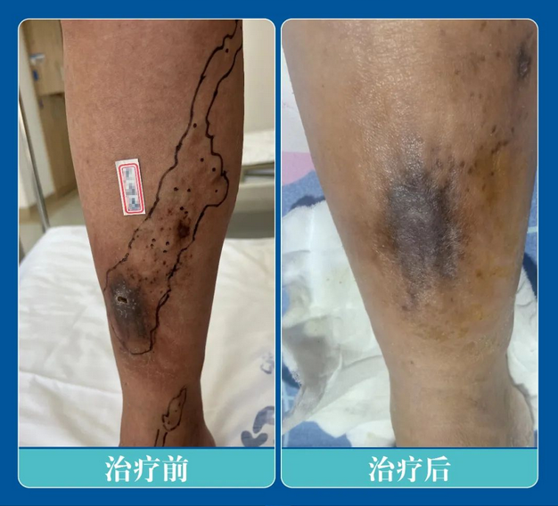 案例实记丨47岁静脉曲张伴溃疡患者微创治疗术后...