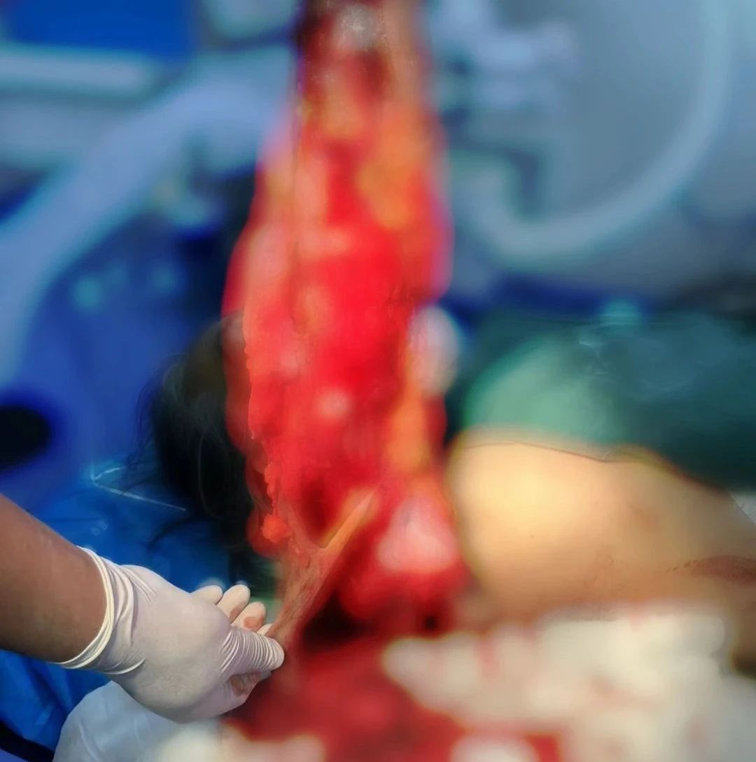 记6月10日严重车祸伤者救治丨多学科联动拯救车祸重伤患者！