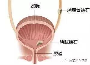 什么是膀胱结石