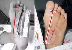 慢性创面难以治愈？陕西冶金医院骨科慢性创面修复中心正式成立