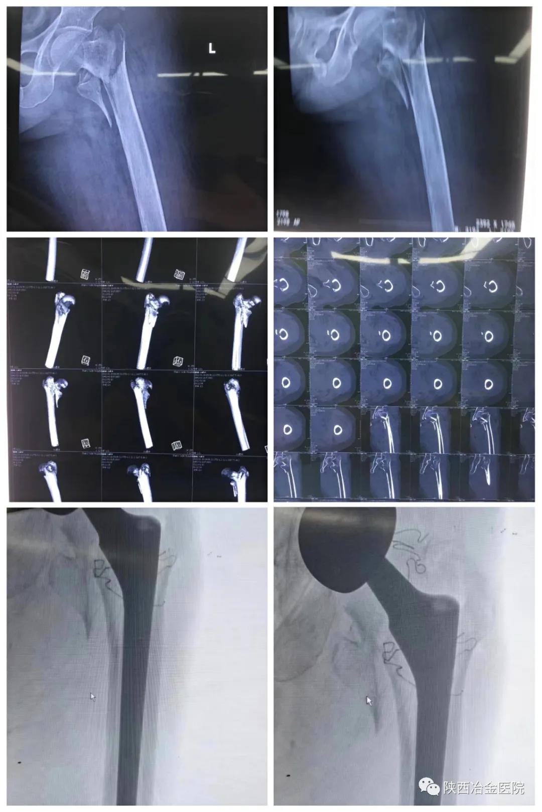（图片）股骨粗隆间骨折的治疗 - 好大夫在线