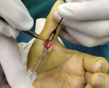 患者福音丨狭窄性腱鞘炎，分分钟松解彻底！