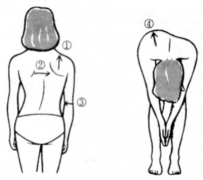 14岁脊柱侧弯女孩，完美变身记！