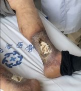 患者自述丨&ldquo;一天比一天好，没想到这么快&rdquo;