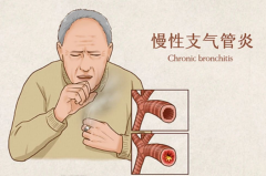 冷空气来袭丨对付老慢支，有这篇文章就够了