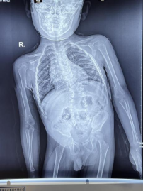 小孩脊椎骨弯曲图片图片